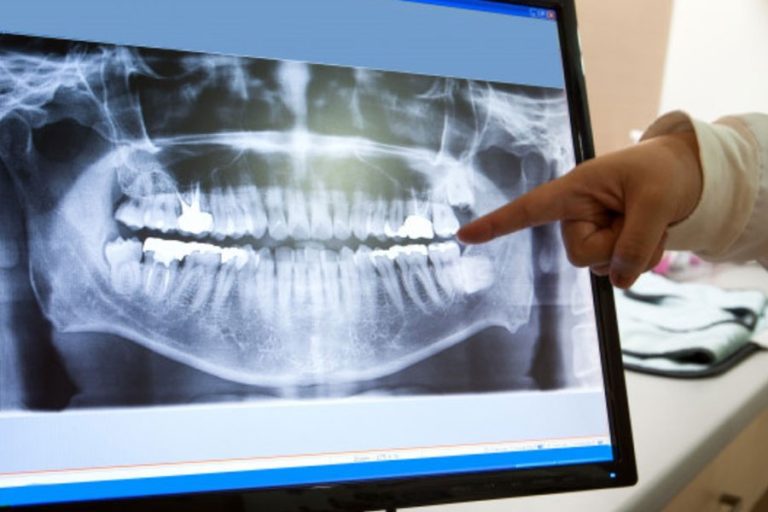 Zobni rentgen Luxdental